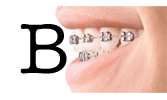 Buying Braces